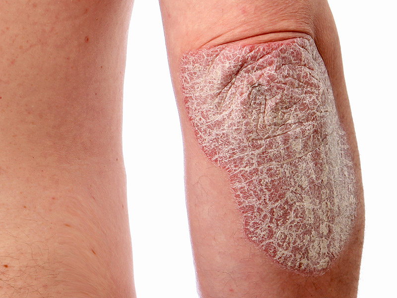 Does Marijuana Help Your Psoriasis? New Health Advisor